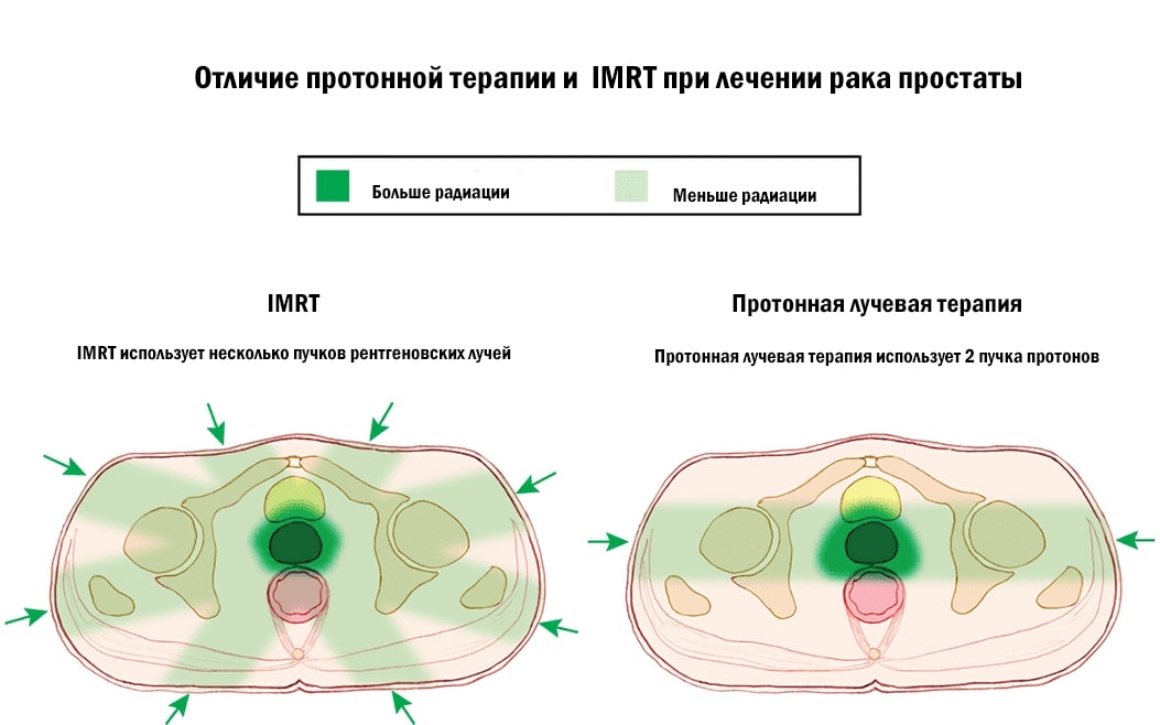 Отличие протонной терапии и  IMRT при лечении рака простаты