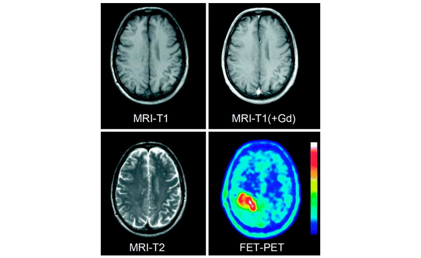 Преимущества визуализации опухоли мозга при ПЭТ КТ с  тирозином по сравнению с МРТ