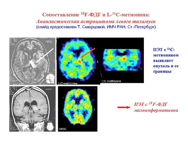 Исследование ПЭТ КТ опухолей головного мозга с 18ФДГ малоинформативно